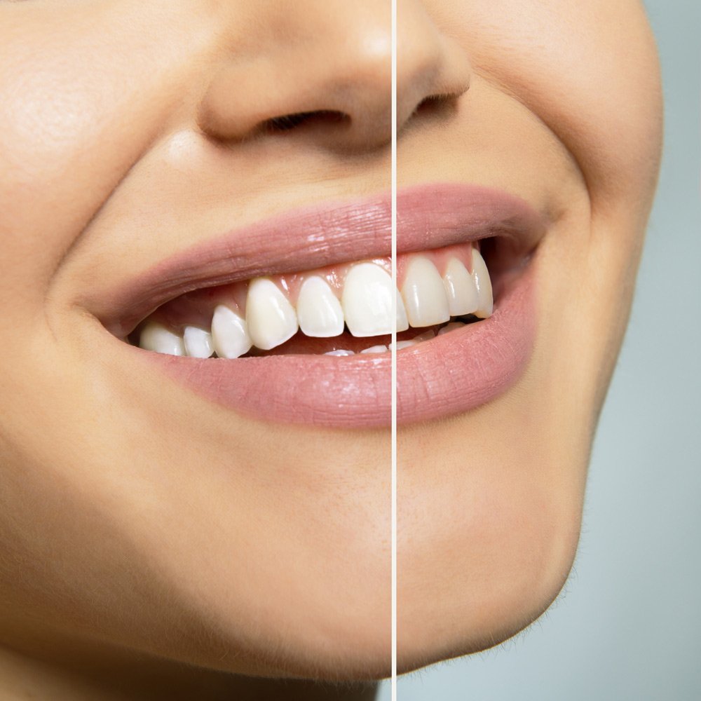 Before And After Teeth Whitening dental - Before And After Teeth Whitening - GPA Dental Group | Dental Clinic Singapore